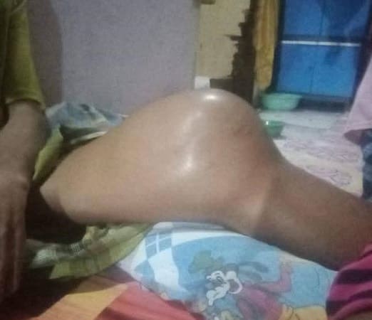 Tumor Kaki