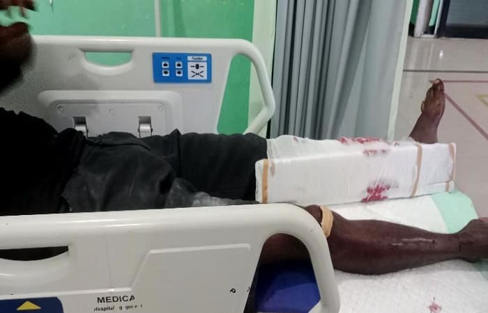 Satu korban patah patah tulang kaki sedang dirawat di RSUD Aeramo. 